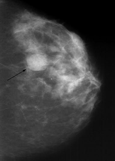 Mammografi, cyste