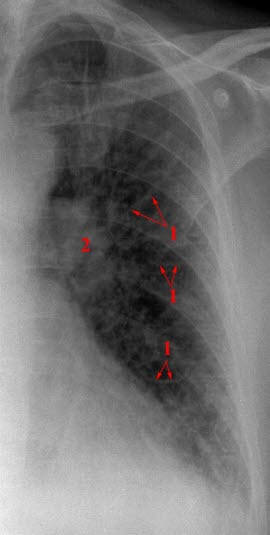 Hjertesvikt, moderat