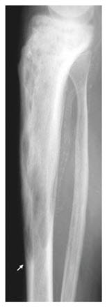 Pagets sykdom, tibia