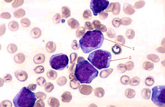 Illustrasjon: Umodne blodceller typisk for blodkreft