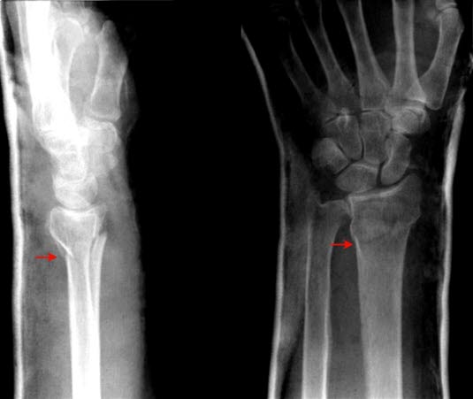 Håndleddsbrudd Håndleddsbrudd