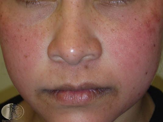 Femte barnesykdom, kinn 2