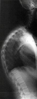 Scheuermanns sykdom Scheuermanns sykdom