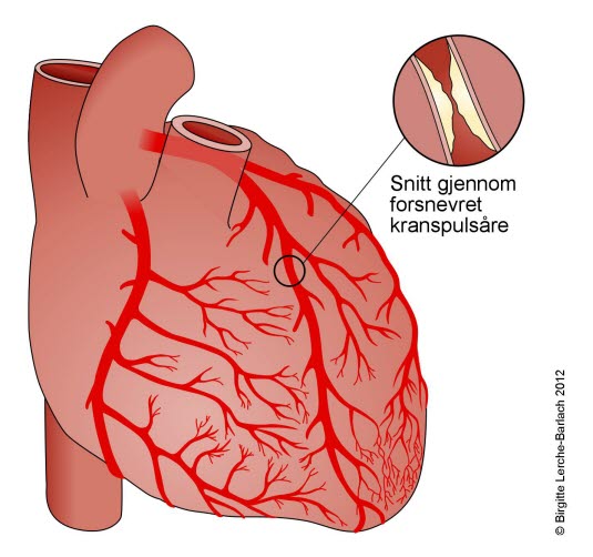 Kranspulsåre, forsnevring