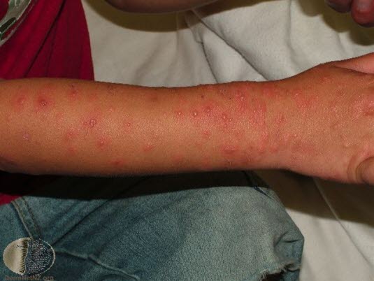 Erythema multiforme, arm