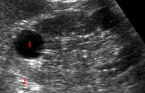 Nyrecyste (ultralyd) Nyrecyste (ultralyd)