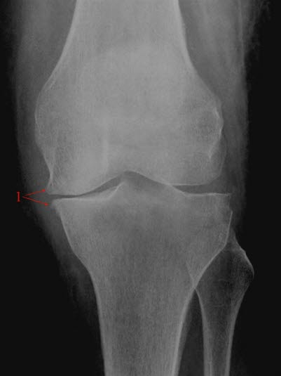 Gonartrose, moderat, front