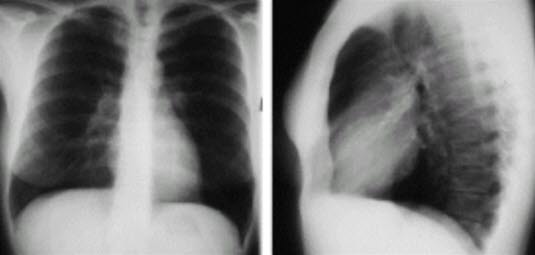 lungeemboli_røntgen