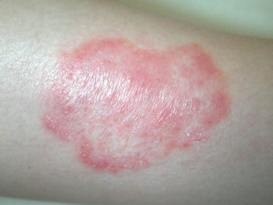 Tinea corporis 2 Tinea corporis 2