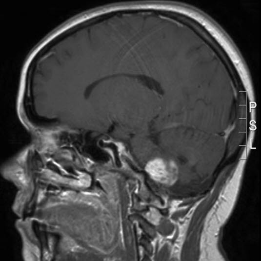 pilocytisk astrocytom who grad i 1 pilocytisk astrocytom who grad i 1