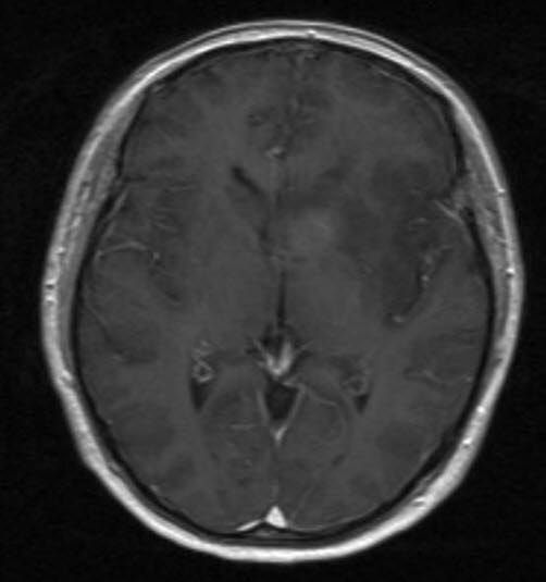 anaplastisk astrocytom who grad iii 1 anaplastisk astrocytom who grad iii 1