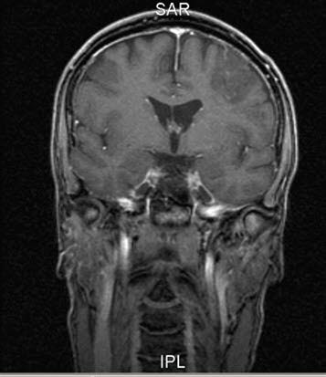 oligodendrogliom 2 oligodendrogliom 2