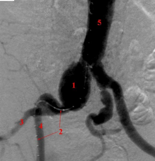Bekkenarterie-aneurisme Bekkenarterie-aneurisme