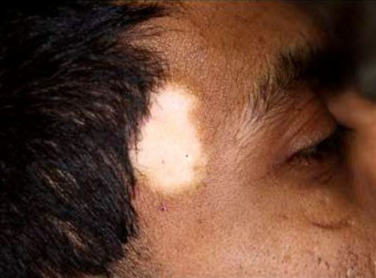 Vitiligo