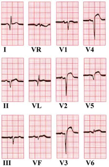 ST-heving i avledningene V2-V5.