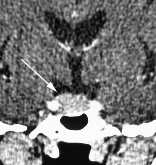 Hypofysetumor (CT) Hypofysetumor (CT)