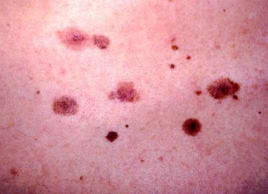 Multiple irregulære nevi hos pasient med dysplastisk nævussyndrom. Typisk er store nevi med diameter mellom 0,5-1 cm. Noe uregelmessig pigmentering er ikke uvanlig, men legg merket til fortsatt fin og  jevn pigmentering ut mot kantene. Nevus til høyre representerer dysplastisk nevus, disse har noe større variasjon i pigmentering og avgrensning.