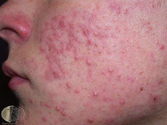 Papulopustuløs akne