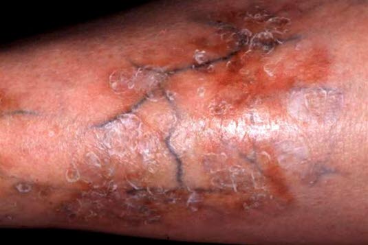 Necrobiosis lipoidica