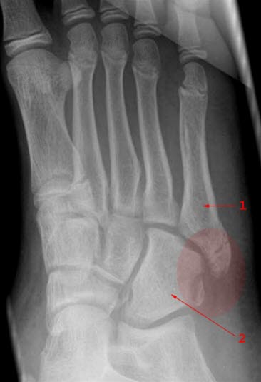 Cuboid metatars fraktur Cuboid metatars fraktur