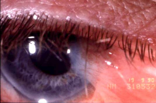 Pterygium, markert