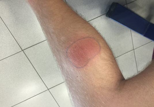 Pasient med erytema migrans på leggen. Utslettet har en jevn farge og man kan ikke se en tydelig ring. Gjengitt med tillatelse fra Flåttsenteret. Pasient med erytema migrans på leggen. Utslettet har en jevn farge og man kan ikke se en tydelig ring. Gjengitt med tillatelse fra Flåttsenteret.