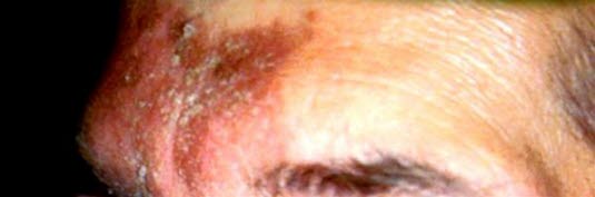 Seborroisk dermatitt, panne Seborroisk dermatitt, panne