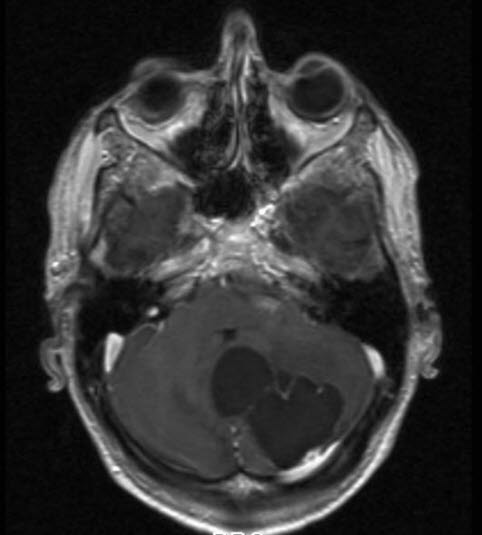 hemangioblastom 1 hemangioblastom 1