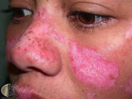 Diskoid lupus erythematosus, ansikt 1