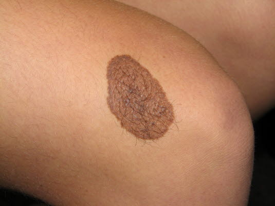 Nevus, medfødt Nevus, medfødt