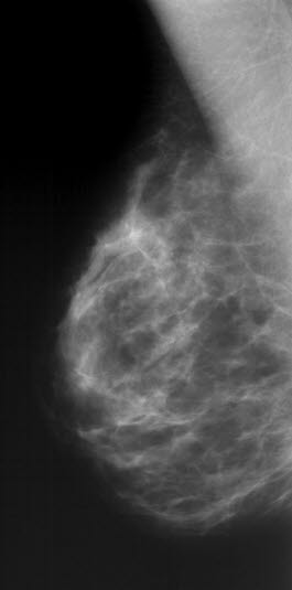 Normalt mammogram