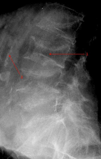Osteoporose lumbalcolumna Osteoporose lumbalcolumna