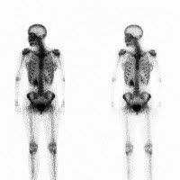 Skjelettscintigrafi Skjelettscintigrafi