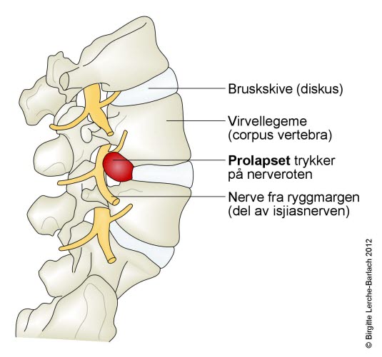 Lumbalt skiveprolaps Lumbalt skiveprolaps
