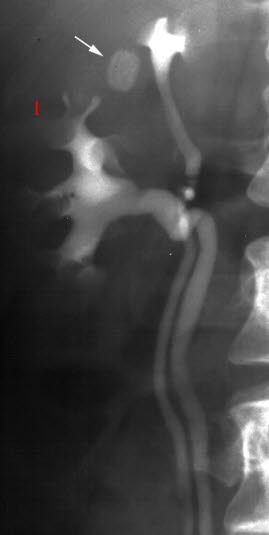 Dobbeltanlegg (urografi)