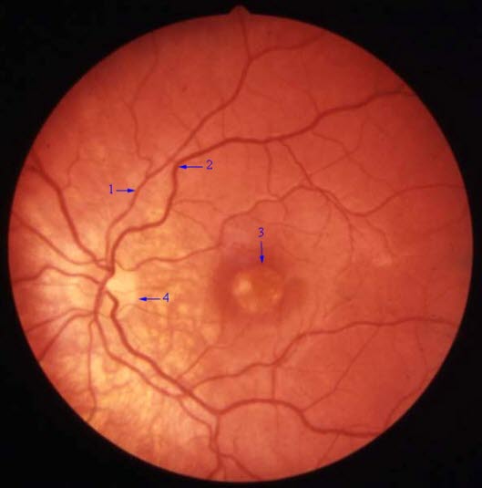 Makuladegenerasjon Makuladegenerasjon