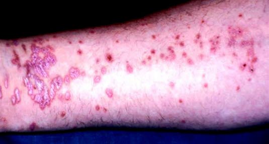 Sterkt kløende, symmetrisk utbredt exanthem med typisk lokalisasjon volart på underarmene. Rødviolette, velavgrensede papler og plaque med noe glinsende overflate.