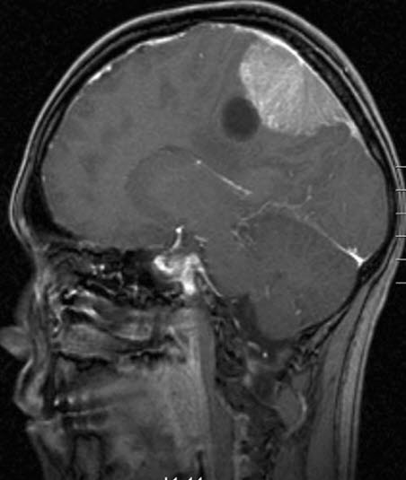 meningiom med cyste 1 meningiom med cyste 1