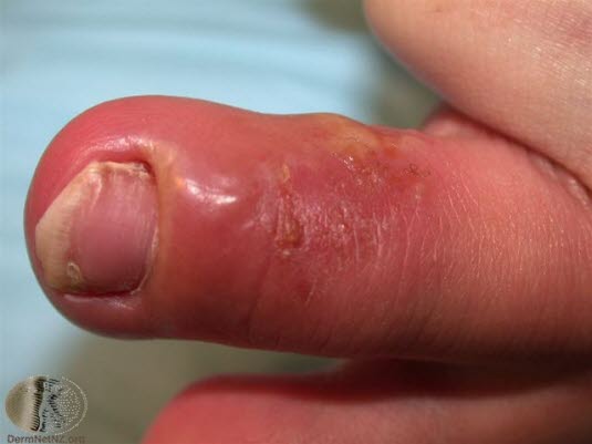 Herpes simplex, Whitlow