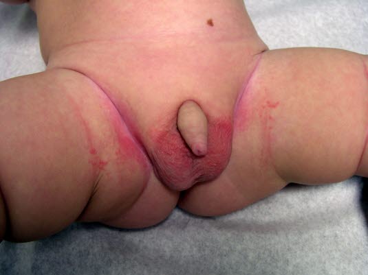 Bleieeksem med sopp.Her er det lite utslett på områder som er i kontakt med bleien.