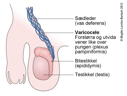 Scrotum - varicocele