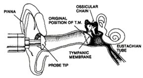 Tympanometer i øregang