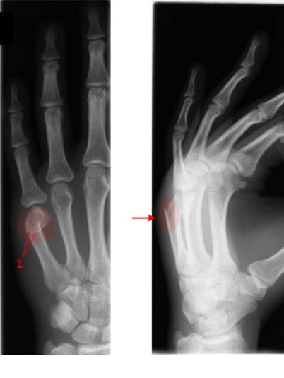 Metacarp 5 fraktur Metacarp 5 fraktur