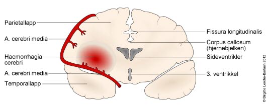 Hjerneblødning Hjerneblødning