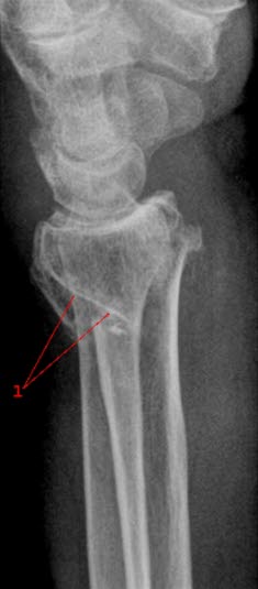 Håndleddsbrudd sett fra siden Håndleddsbrudd sett fra siden