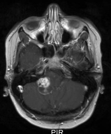 pilocytisk astrocytom who grad i 2 pilocytisk astrocytom who grad i 2