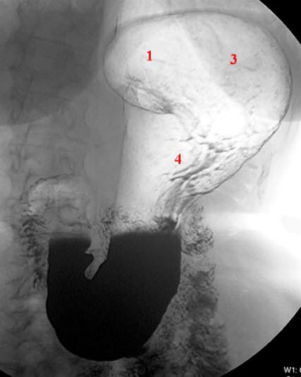 Ventrikkel normal, stående Ventrikkel normal, stående