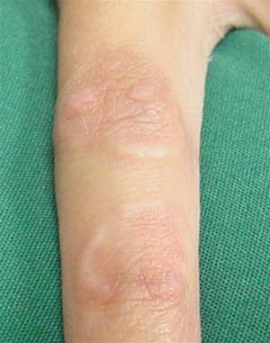 Lokalisert granuloma annulare. Fra American Family Physician.