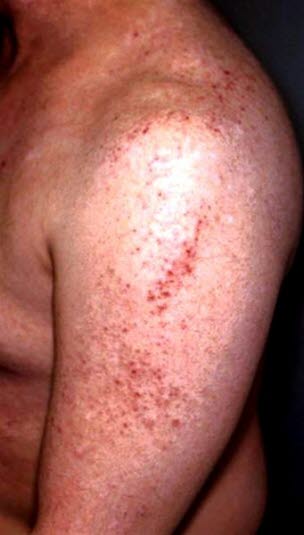 Atopisk eksem på skulder