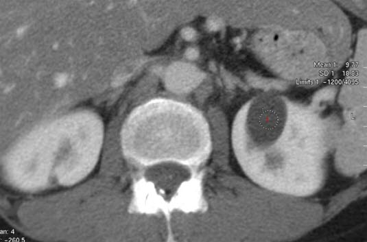 Nyrecyste (CT) Nyrecyste (CT)